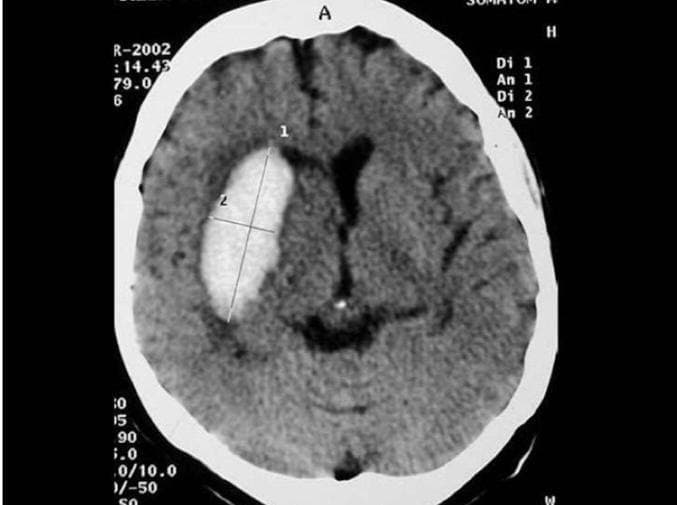 Tomografia axial com alteração hemorrágica no acervo de neoplasia