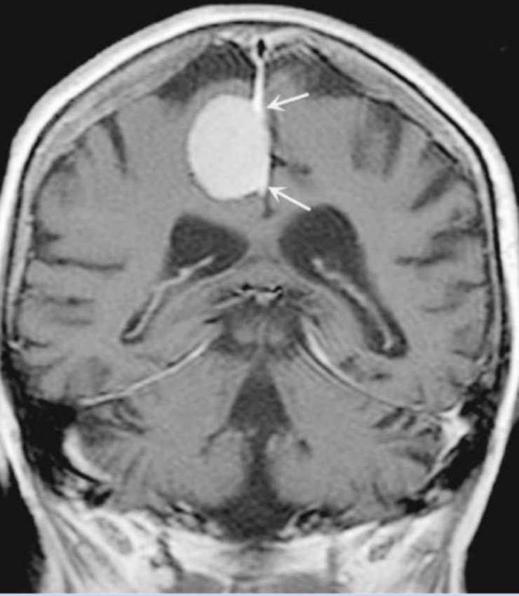 Ressonância coronal com lesão extra-axial