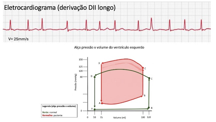 Eletrocardiograma e gráfico pressão-volume do caso clínico da avaliação