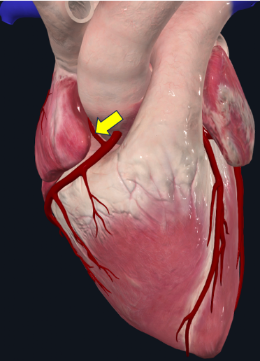 Modelo cardíaco em vista anterior, com seta amarela sobre um ramo arterial fino que ascende na superfície direita.