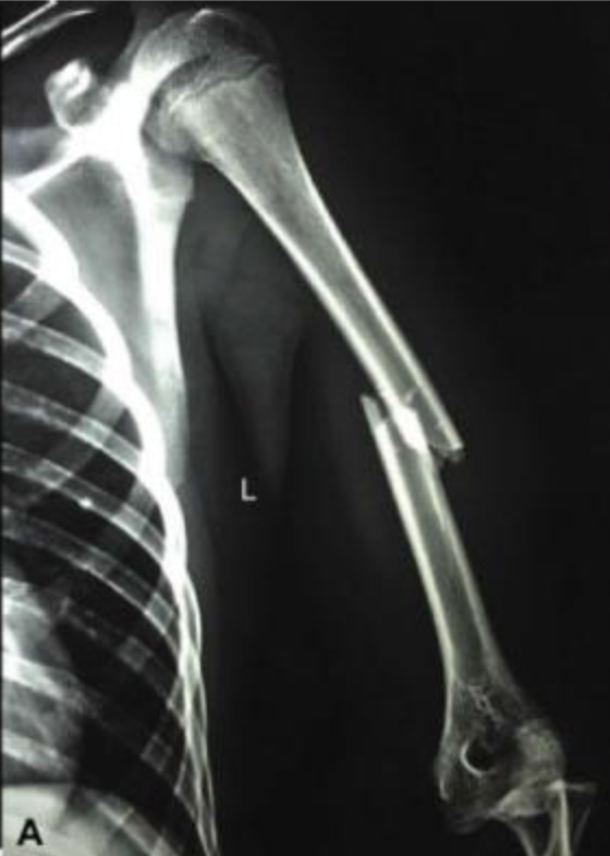 Radiografia do úmero com fratura deslocada no terço médio do osso.