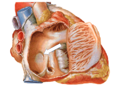 Modelo do átrio direito aberto, com seta sobre depressão do septo interatrial.