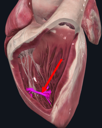Modelo do ventrículo direito aberto, com faixa muscular interna destacada.