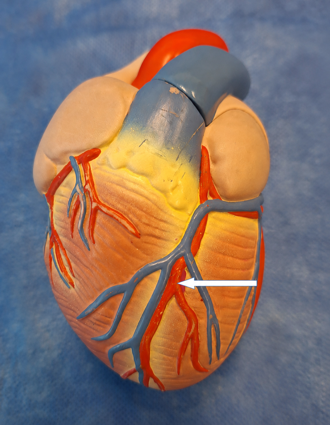 Modelo cardíaco anterior com seta sobre um vaso vermelho no sulco interventricular anterior.
