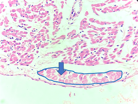 Micrografia da parede cardíaca, com área subendocárdica de células grandes e pálidas circundada.