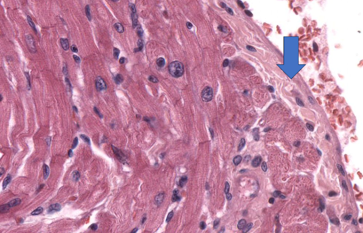 Micrografia da parede cardíaca, com seta sobre o revestimento luminal delgado.