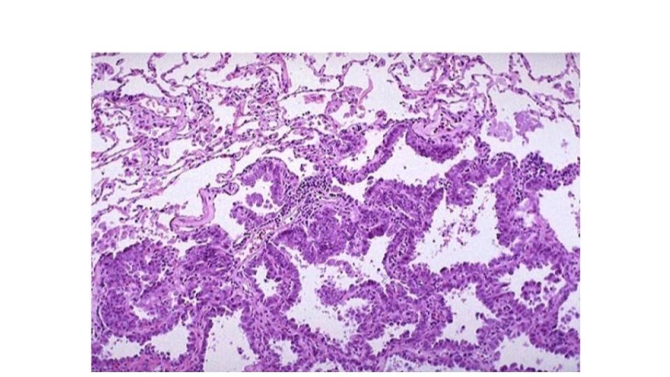 Micrografia pulmonar com proliferação glandular acompanhando septos alveolares preservados em padrão lepídico.