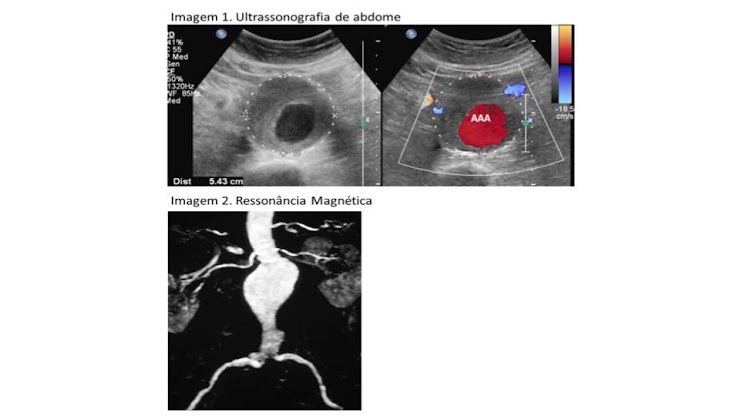 Ultrassonografia com Doppler e angiorressonância mostrando dilatação aneurismática da aorta abdominal.