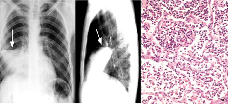 Radiografias de tórax em duas incidências com consolidação indicada por setas e micrografia mostrando alvéolos preenchidos por exsudato inflamatório.
