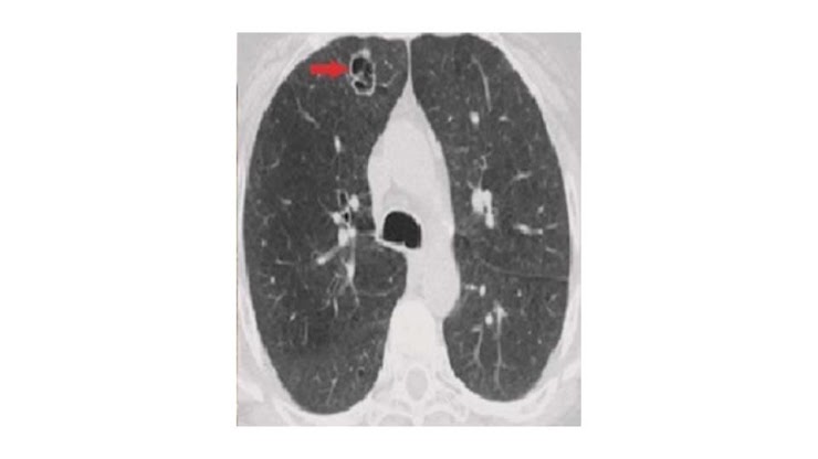 Tomografia axial do tórax com cavidade de parede espessa no ápice pulmonar direito indicada por seta.